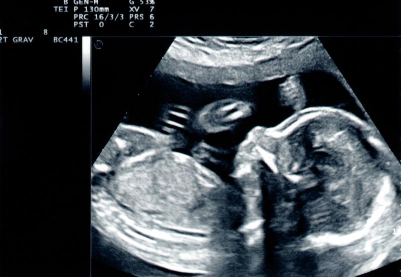 Kluczowe informacje na temat ultrasonografii w trakcie ciąży